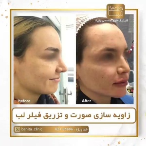 زاویه-سازی-صورت-8