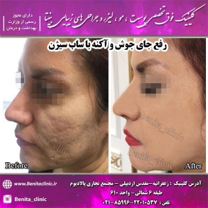 سابسیژن-1