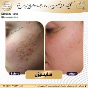 سابسیژن3