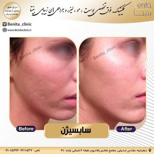 سابسیژن4
