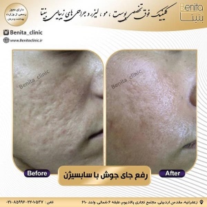سابسیژن5