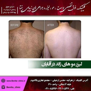 لیزر-موهای-زائد2