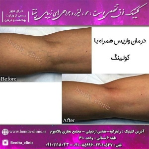 لیزر-کوترا3