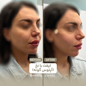 لیفت-صورت-5