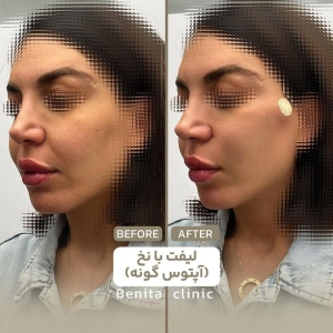 لیفت-صورت-6