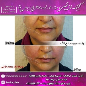 لیفت-صورت1-