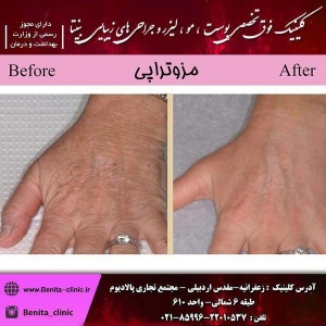 مزوتراپی-1