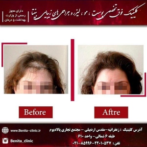 مزوتراپی-3