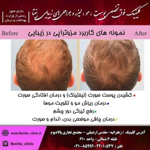 مزوتراپی2