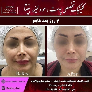 هایفوتراپی-1