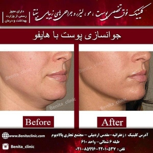هایفوتراپی-2