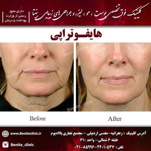 هایفوتراپی-3