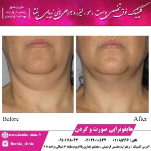 هایفوتراپی-4