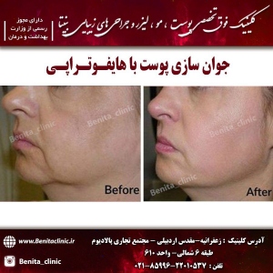 هایفوتراپی