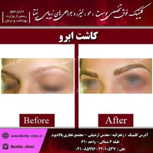 کاشت-مو-و-ابرو-1