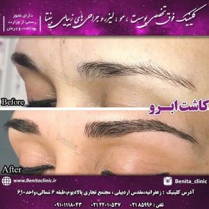 کاشت-مو-و-ابرو-2
