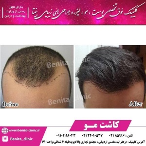 کاشت-مو-و-ابرو-3