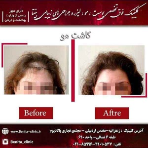 کاشت-مو