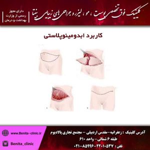ابدومینوپلاستی