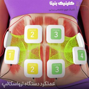 عملکرد دستگاه ترواسکالپ