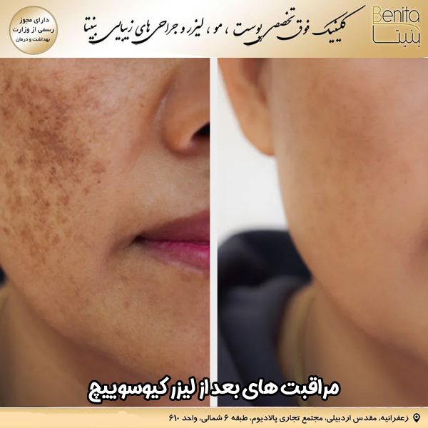 مراقبت‌ های بعد از لیزر کیوسوییچ - کلینیک بنیتا https://benita-clinic.ir/