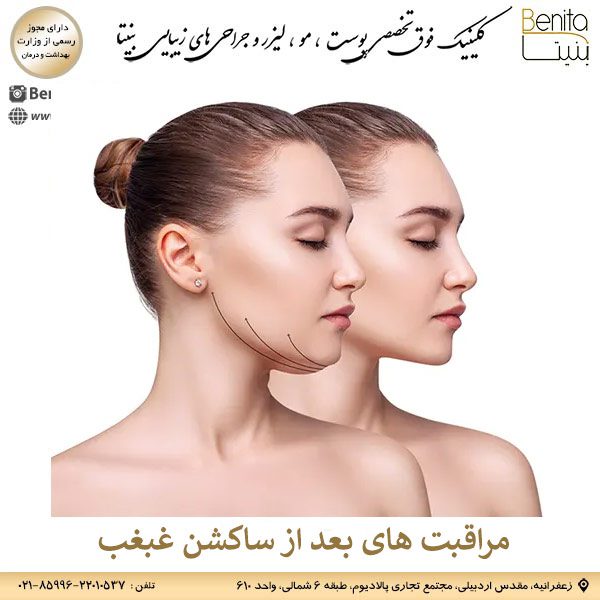 مراقبت های بعد از ساکشن غبغب _ کلینیک بنیتا