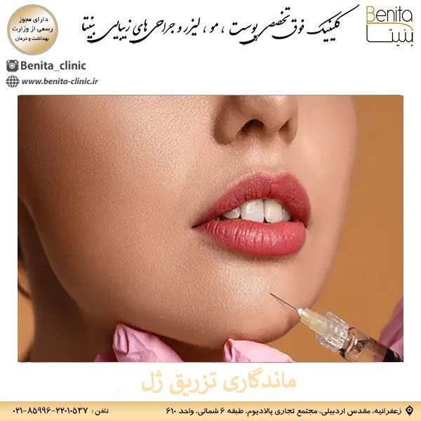 ماندگاری تزریق ژل _ کلینیک بنیتا