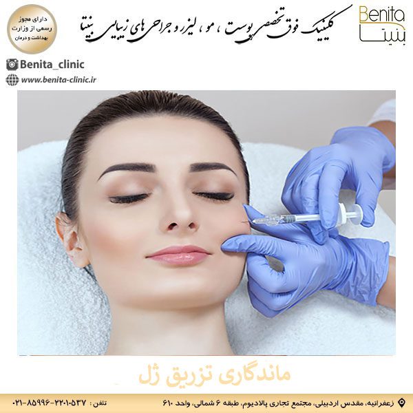 ماندگاری تزریق ژل گونه _ کلینیک بنیتا