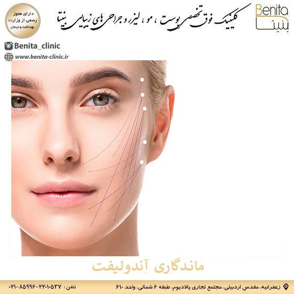 ماندگاری آندولیفت _ کلینیک بنیتا