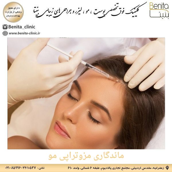 ماندگاری مزوتراپی مو _ کلینیک بنیتا