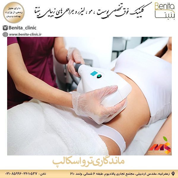 ماندگاری ترواسکالپ _ کلینیک بنیتا