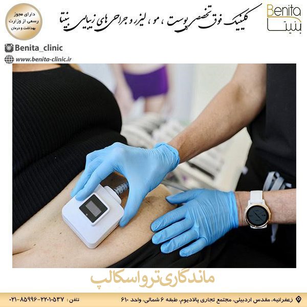 ماندگاری ترواسکالپ _ کلینیک بنیتا